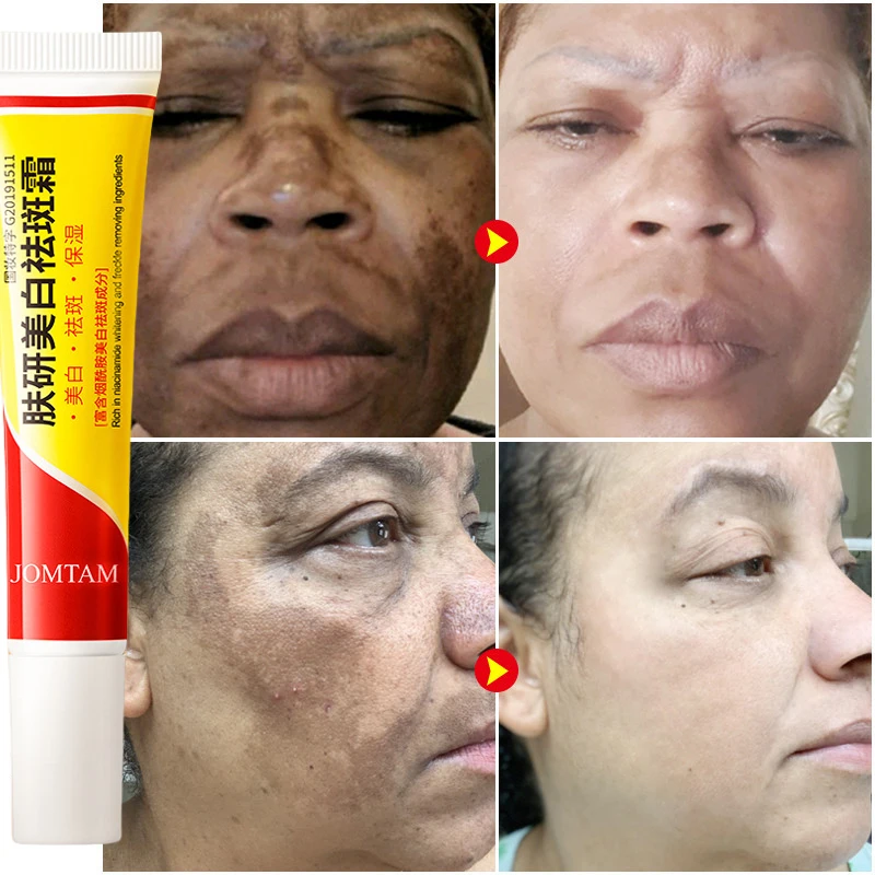 Отбеливающий крем от веснушек, – обзор и цена Skincare Glad2Glow